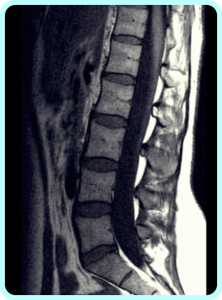 요추 MRI